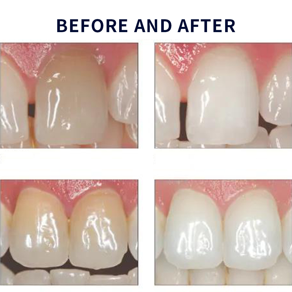 家庭用UV患者セット,プロの衛生機器,紫外線,16%,歯科材 - Teeth Whitening With Peroxide のレビューと価格