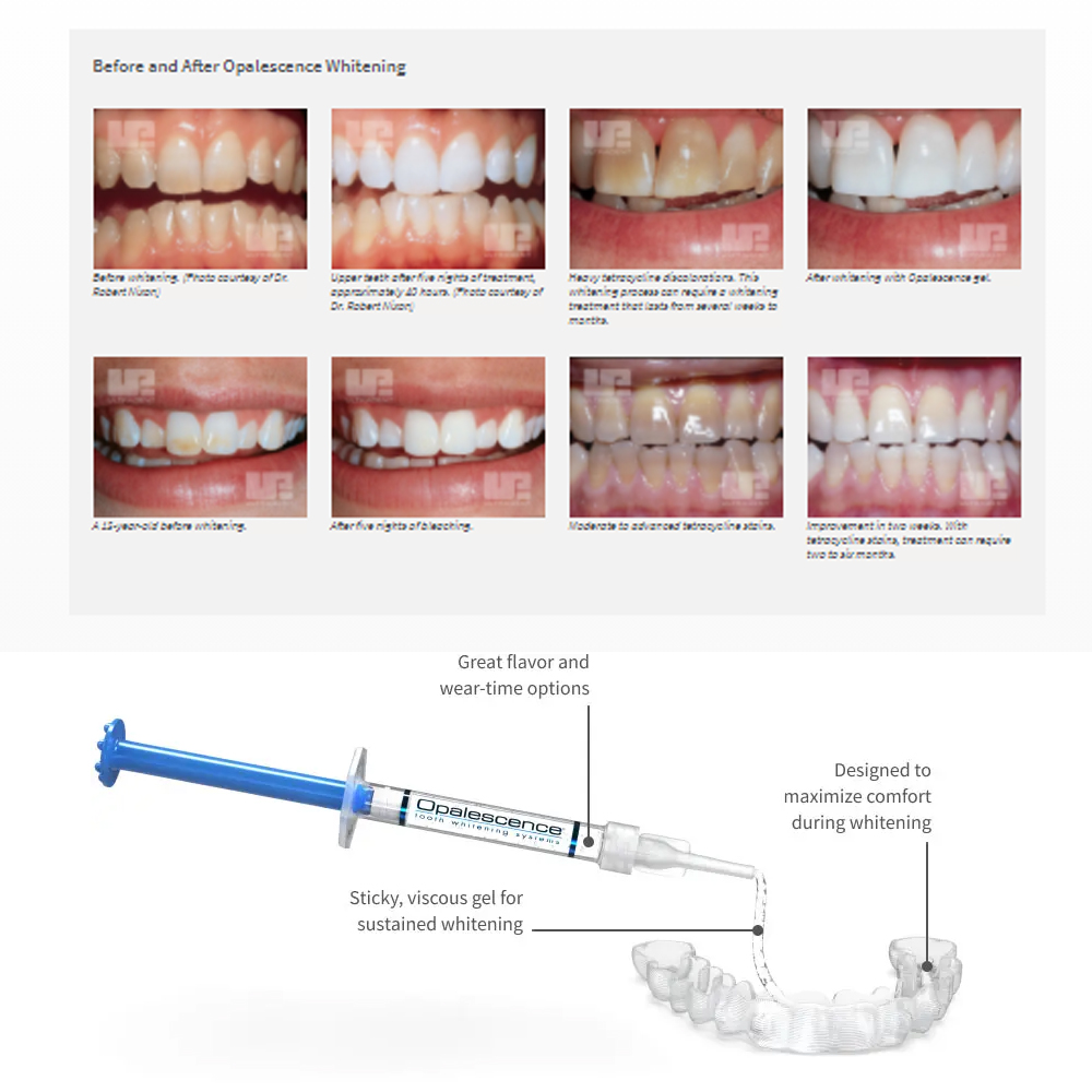 家庭用UV患者セット,プロの衛生機器,紫外線,16%,歯科材 - Teeth Whitening With Peroxide のレビューと価格