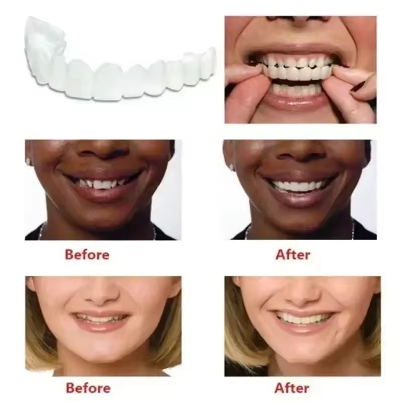 歯のベニア、ホワイトニング、入れ歯、歯列矯正、一時的な義歯カ - Teeth Whitening Veneers のレビューと価格