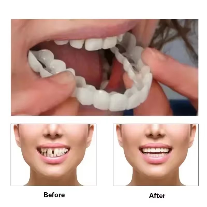 歯のベニア、ホワイトニング、入れ歯、歯列矯正、一時的な義歯カ - Teeth Whitening Veneers のレビューと価格