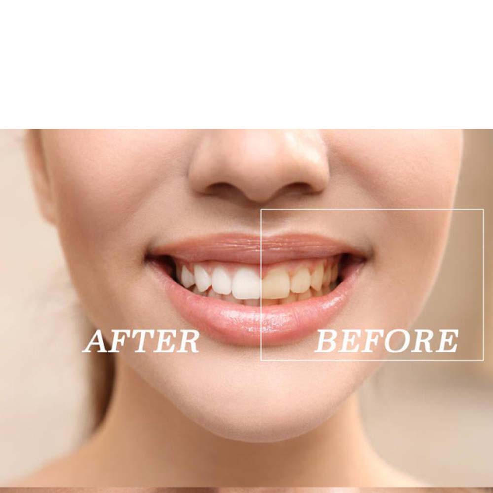 歯のホワイトニングキット,高品質の製品,過酸化物,明るい白, - Teeth Whitening With Peroxide のレビューと価格