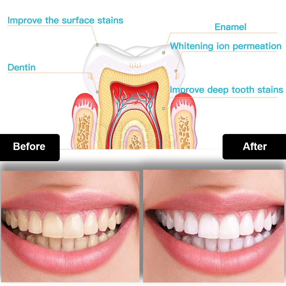 歯科歯ホワイトニングキットミニ 16 LED コールドライト - Teeth Whitening Foam のレビューと価格